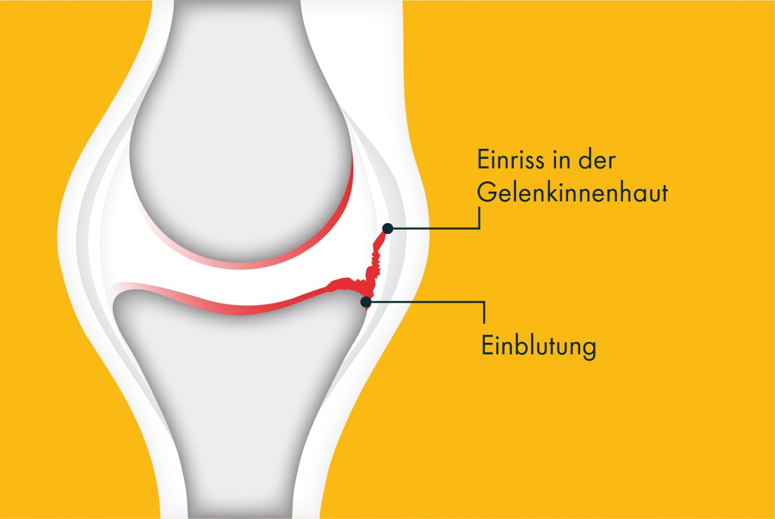 Was ist Hämophilie? Symptome, Ursachen von Hämophilie A