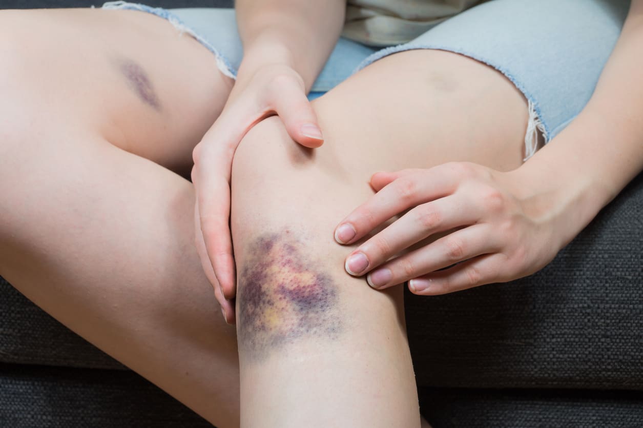 Gerinnungsstörungen bei Frauen mit Hämophilie